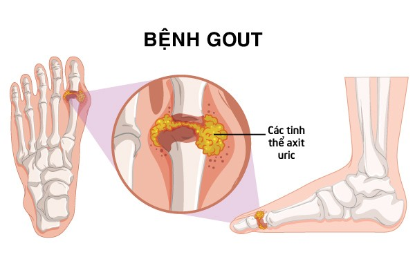 Người bị gout có nồng độ acid uric máu tăng cao