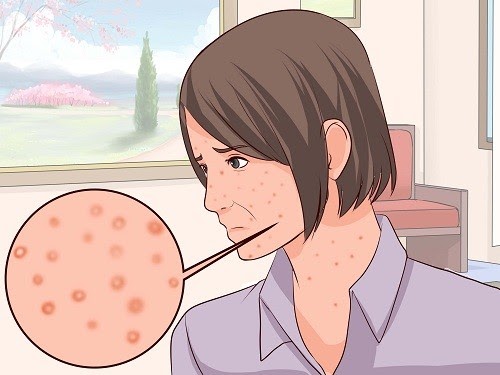 Bệnh thủy đậu có thể gây biến chứng nhiễm trùng da dẫn đến sẹo thâm lõm