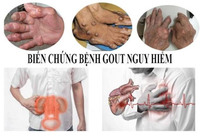 Bệnh gout gây nhiều biến chứng trên các cơ quan khác nhau trong cơ thể