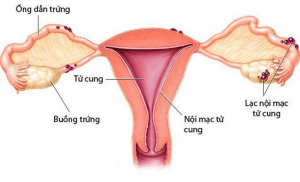 Lạc nội mạc tử cung ảnh hưởng đến sức khỏe sinh sản của phụ nữ