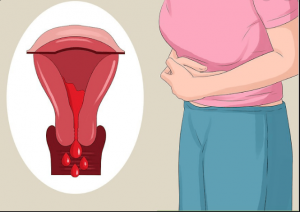 Lạc nội mạc tử cung có thể khiến cho phụ nữ vô sinh