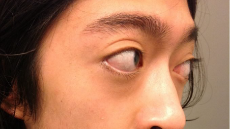 Người mắc bệnh Basedow dễ gặp phải tình trạng lồi mắt, chảy nước mắt