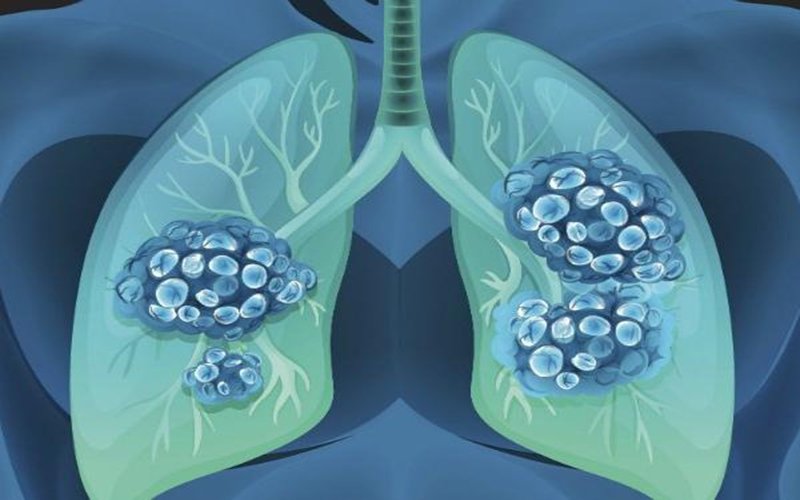 Hình ảnh mô tả phù phổi cấp