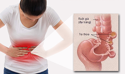 Đau bụng- triệu chứng thường gặp trong viêm túi thừa đại tràng